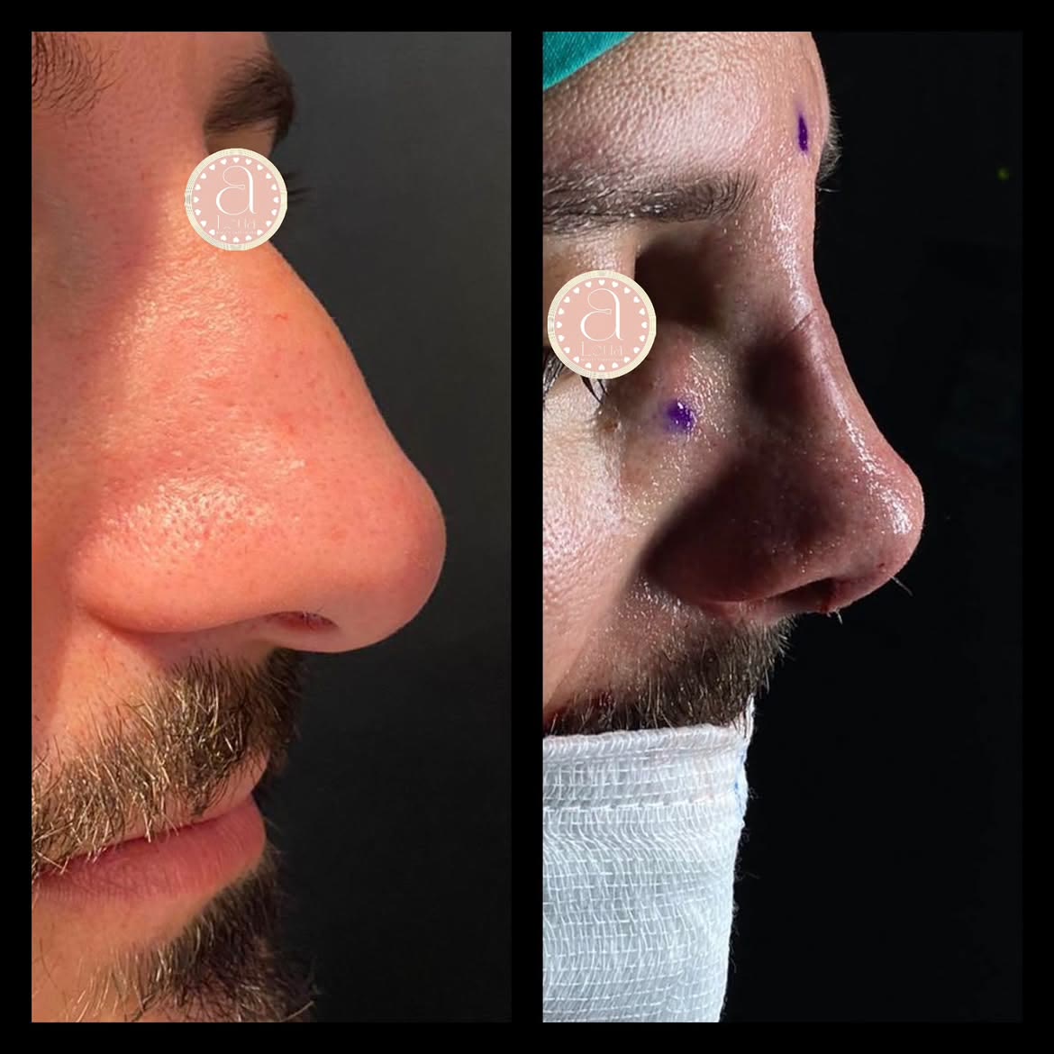 Antes y después de rinoplastia