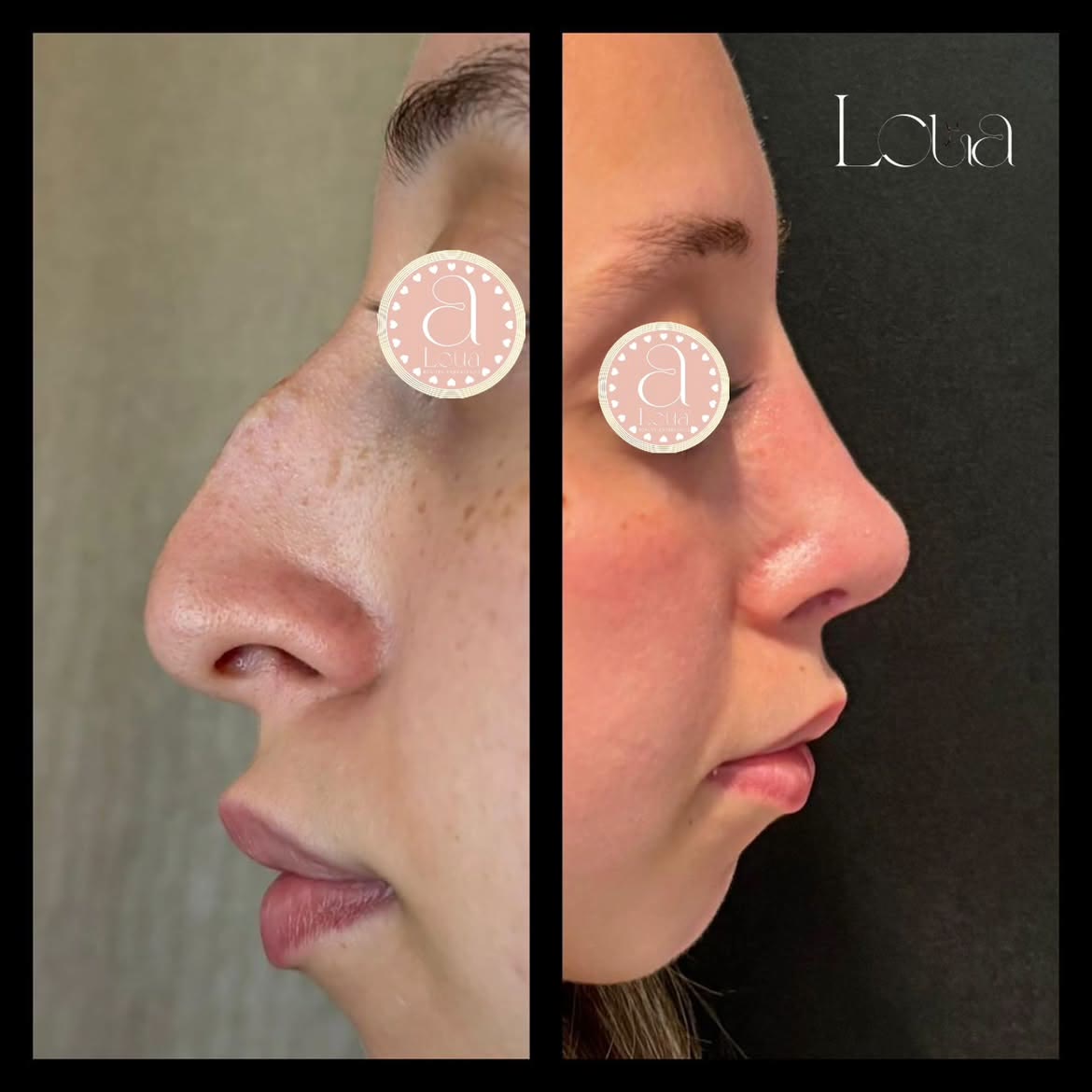Antes y después de rinoplastia
